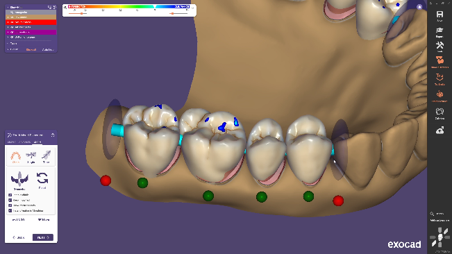 图片[7]-Exocad DentalCAD数字化牙科CAD CAM软件-知遇博客